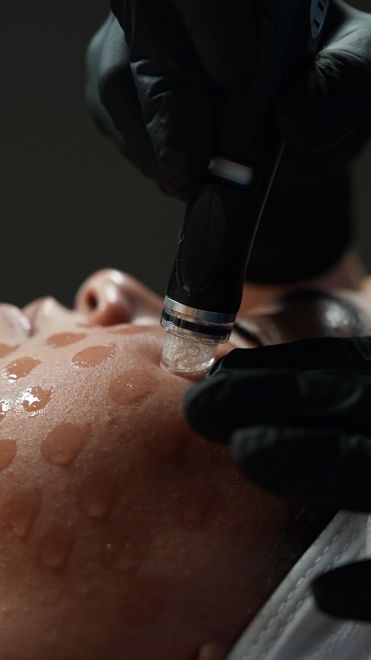 Microneedling